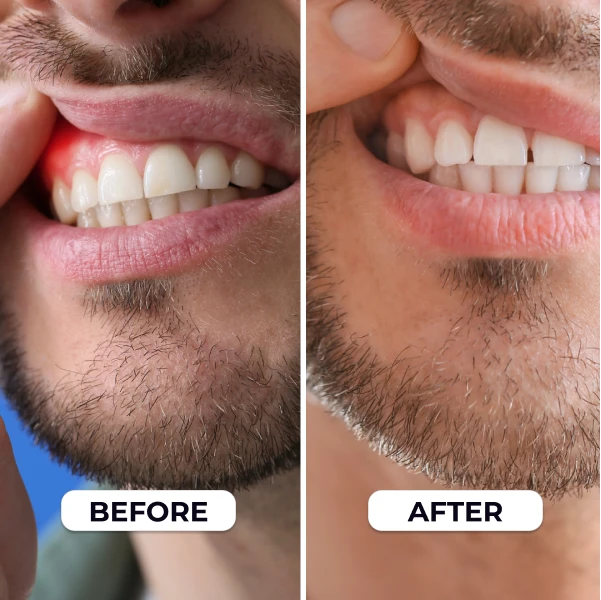 PrimeDenta | Image | 7 Reason  | Showing Teeth - Before-After