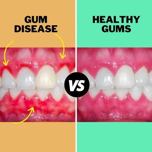PrimeDenta | Image | 7 Reason| Disease vs Healthy Gums
