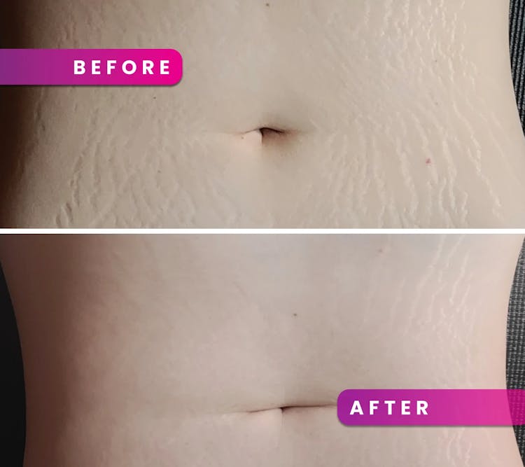 Vitauthority | Image| Before-After | Cellulite Stomach transformation