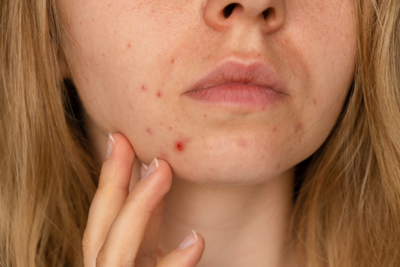 Scars and Hyperpigmentation